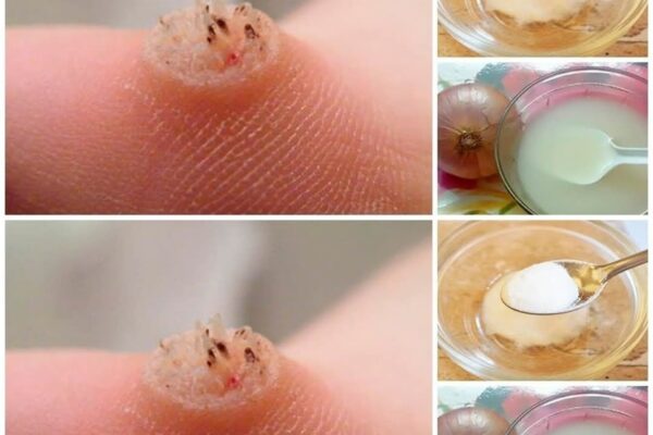 How to Remove Warts Naturally…