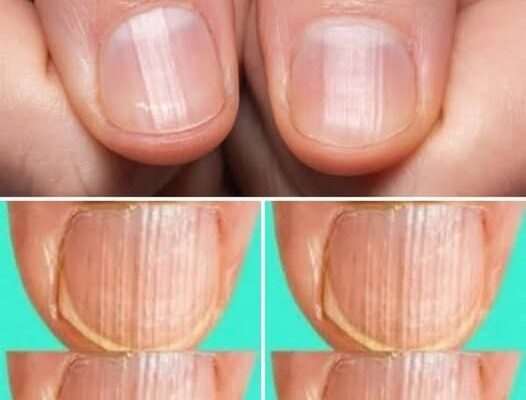 Rippled fingernails reveal secrets of possible disease
