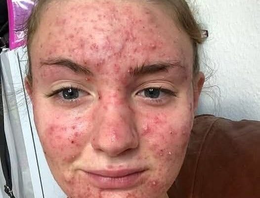 Her body was itching, I thought it was an allergy!